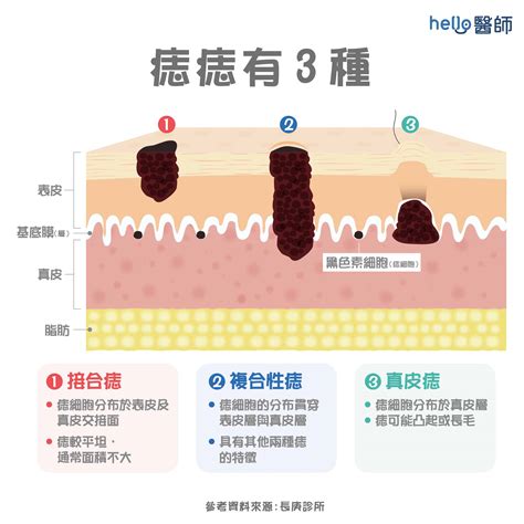 陰囊 黑痣|陰莖及陰囊上的痣：該如何處理？